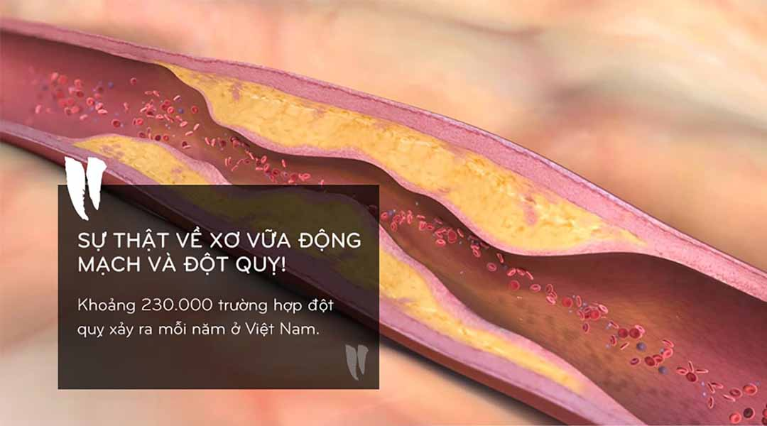 Đột quỵ từ xơ vữa mạch, vì đâu nên nỗi?